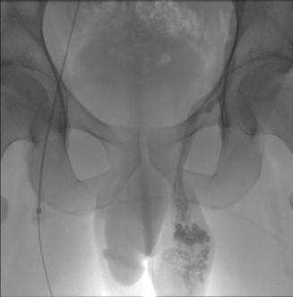 Prise en charge radiologique de la varicocèle : du diagnostic au ...