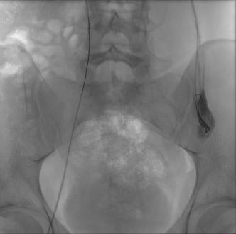 Prise en charge radiologique de la varicocèle : du diagnostic au ...