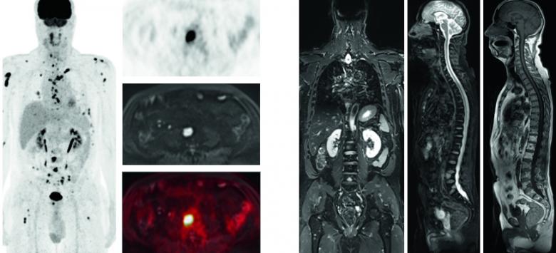 Imagerie Myelome