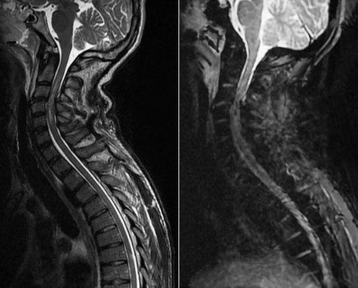 Traumatisme du rachis cervical bas et IRM cervicale en urgence ...