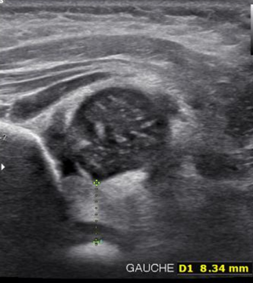  LCH:  le  fond  cotyloïdien  est  supérieur  à  6  mm  et  mesuré  à  8,34  mm.  La  tête  fémorale  n’est  pas  au  centre  du  cotyle  et  le  labrum  n’est  pas  recouvrant.  Un  avis  spécialisé  pédiatrique  est  requis  rapidement.