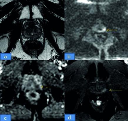 IRM Prostate