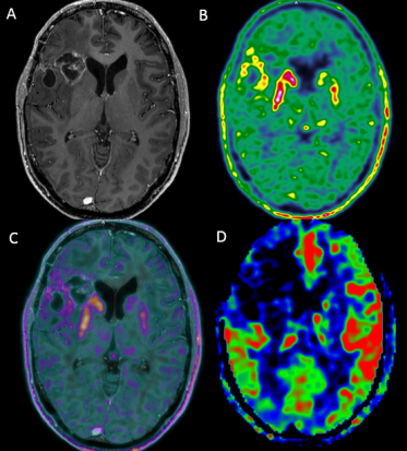 Place de la TEP-IRM en neuro-imagerie clinique | SFR e-Bulletin
