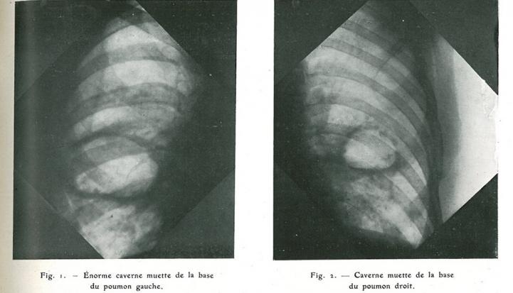 Fig. 3 : Cavernes muettes tuberculeuses et fausses cavernes du poumon. Mémoire J . Aimard, Service central de radiologie de la 13e région. Journal de Radiologie et d’électrologie mars-avril 1918 (T III) : 49-52.