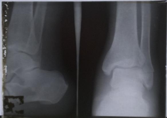 Fig. 4 : Radiographie sur verre 1916 en double incidence par souci d’économie (Coll. SFR. Don du Dr Michel Perret).