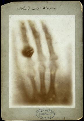 radiographie de la main d'Anna Bertha Röntgen 22 décembre 1895