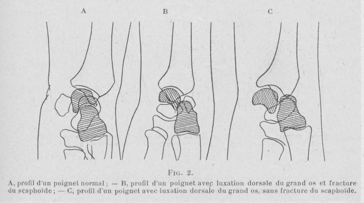 fig 2 poignet fig 2 poignet