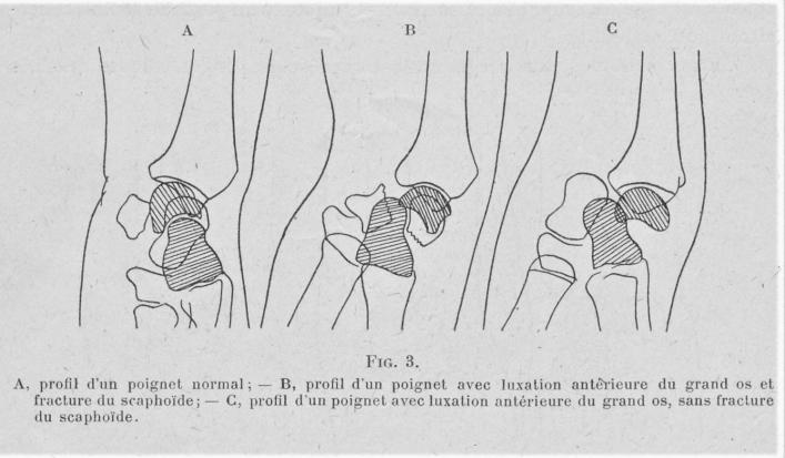 fig 3 poignet fig 3 poignet