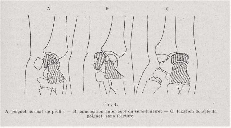 fig 4 poignet fig 4 poignet