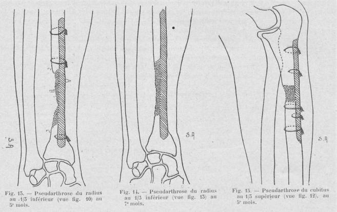 pseudarthrose
