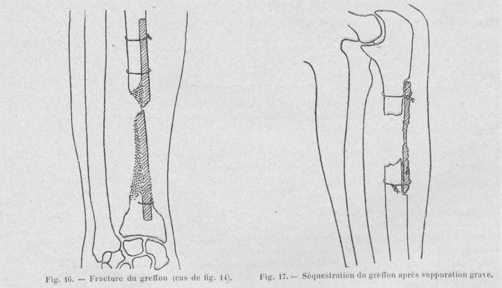 pseudarthrose