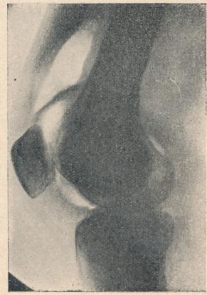 pneumarthrose du genou