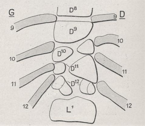 double spina bifida antérieur