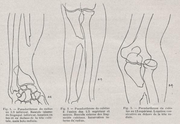 PDF) Traitement de la pseudarthrose du radius par greffe osseuse et plaque  vissée. A propos d'un cas et revue de la littérature