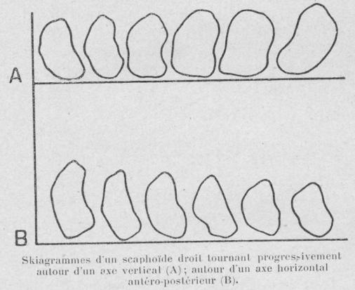skiagramme du scaphoide