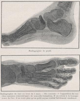 scaphoidite tarsienne du jeune enfant