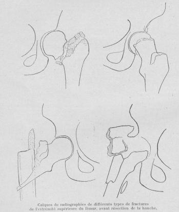 plaies articulaires de la hanche