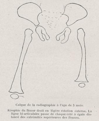 atrophie congénitale du fémur