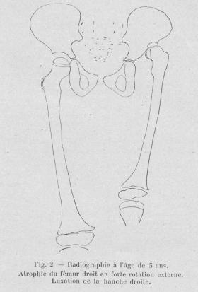 atrophie congénitale du fémur