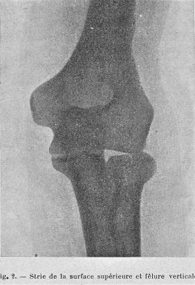 Fig. 2 : Strie de surface sans déplacement