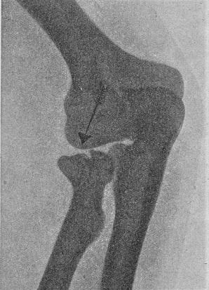 Fig. 3 : Intérêt de l’incidence oblique