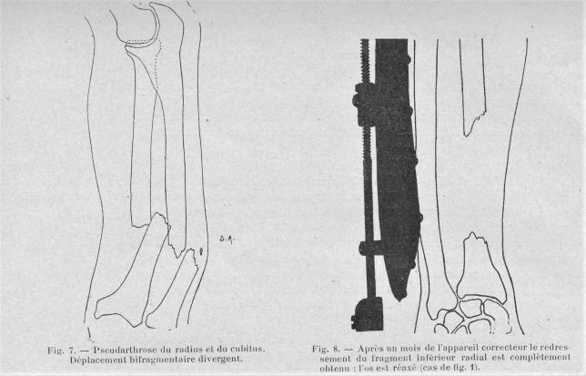 pseudarthrose