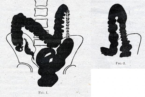 Lavement sténose du colon descendant 