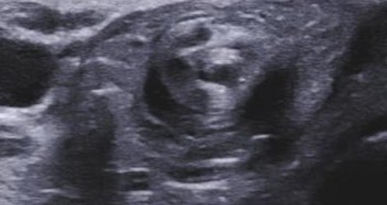 Plaidoyer Pour L Echographie Technique D Imagerie Incontournable En Pediatrie Sfr E Bulletin Plaidoyer Pour L Echographie Technique D Imagerie Incontournable En Pediatrie Sfr E Bulletin