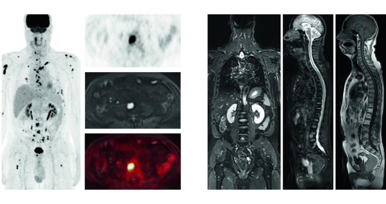 Imagerie Myelome