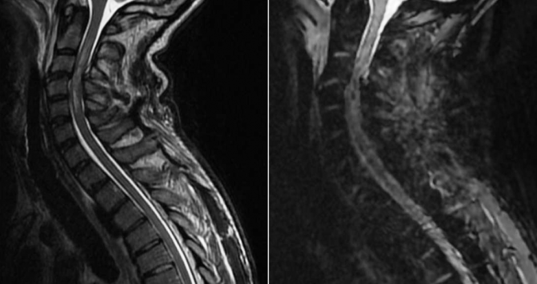 IRM  cervicale,  séquences  sagittales  pondérées  T2  et  T2*  :  contusion  médullaire  hémorragique  en  regard  de  C3-C4.