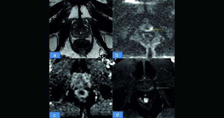 IRM prostate