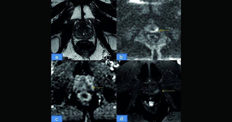 Irm De Prostate Avant Biopsie Sfr E Bulletin