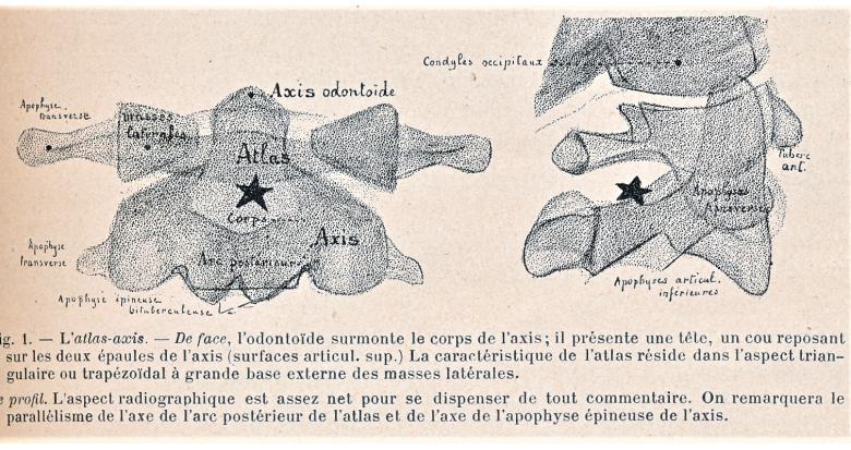 la radiographie du mal de Pott sous occipital la radiographie du mal de Pott sous occipital