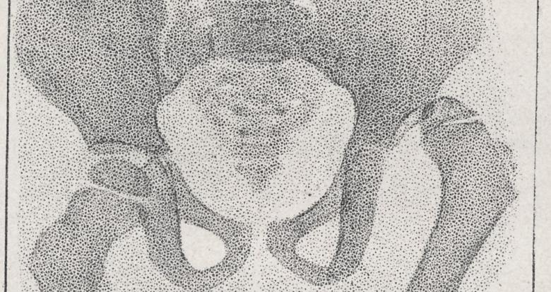 luxation de la hanche consecutive aux maladies infectieuses