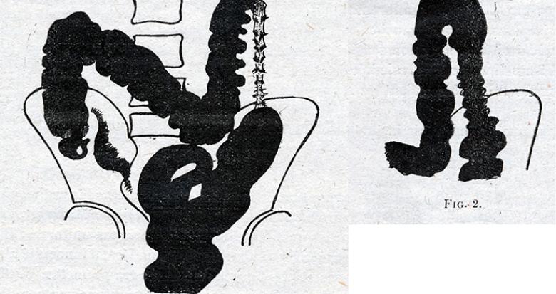Lavement sténose du colon descendant Lavement sténose du colon descendant