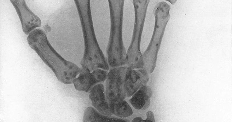 Radiographie de la main gauche vue par sa face palmaire
