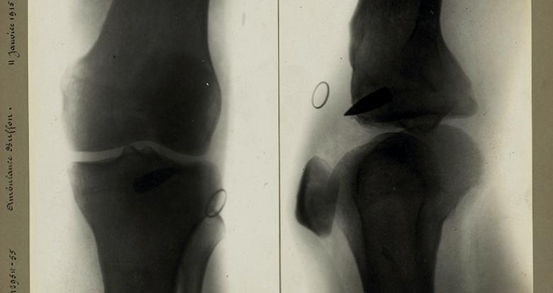 radiographie projectile genou 1915