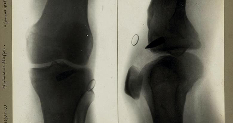 radiographie projectile genou 1915