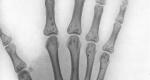 Radiographie de la main gauche vue par sa face palmaire